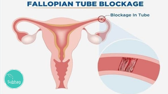 Blocked Fallopian Tubes – A Major Cause of Female Infertility
